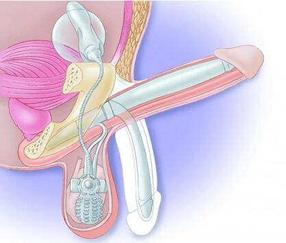 Penilní protéza obnoví erekci a zvětší penis