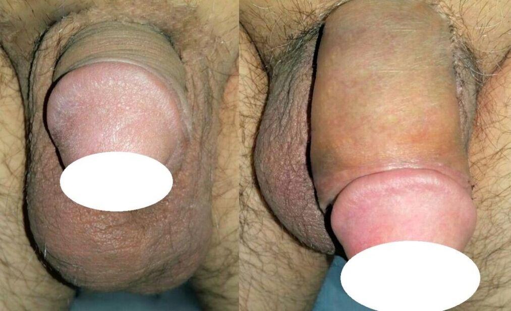 fotografie před a po zvětšení penisu